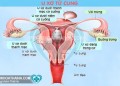 Bệnh u xơ cổ tử cung và những điều quan trọng cần lưu ý