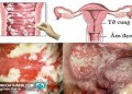 Bệnh viêm âm đạo ở phụ nữ là gì? Nguyên nhân do đâu?