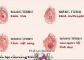 Rách màng trinh có chảy máu không? Bao lâu thì lành?