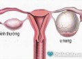 Triệu chứng của bệnh u nang cổ tử cung
