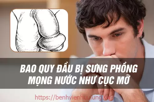 Bao quy đầu bị sưng mọng nước và phồng lên như cục mỡ