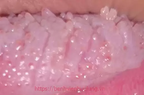 Bệnh sùi mào gà