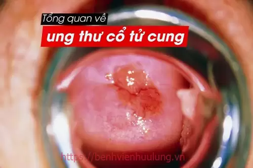 Tổng quan về bệnh ung thư cổ tử cung
