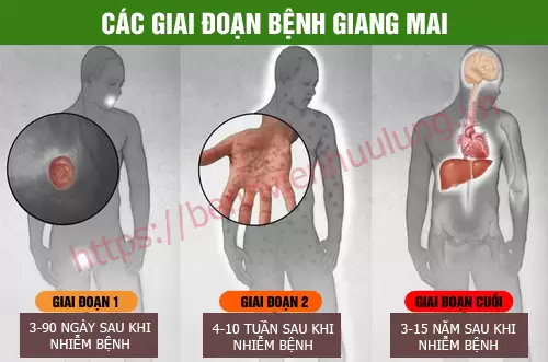 Các giai đoạn bệnh giang mai phát triển