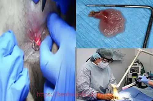 5 phương pháp chữa bệnh sùi mào gà hiện nay