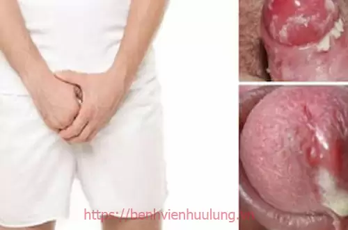 Hình ảnh dấu hiệu bệnh lậu ở nam giới
