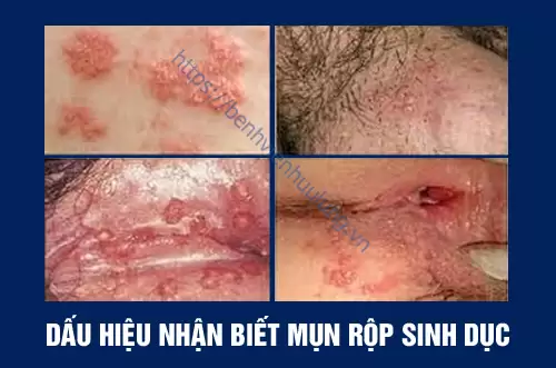 Điều trị mụn rộp sinh dục