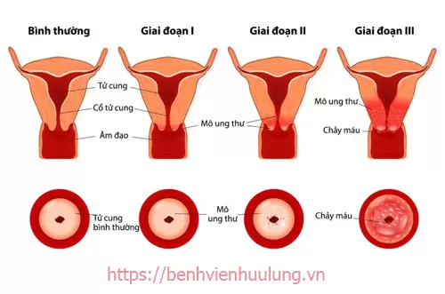 Dấu hiệu nhận biết bệnh ung thư cổ tử cung các giai đoạn