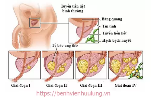 Các giai đoạn phát triển của bệnh phì đại tuyến tiền liệt ở nam giới