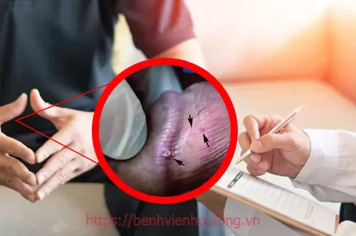 Dấu hiệu bệnh sùi mào gà nam giai đoạn đầu