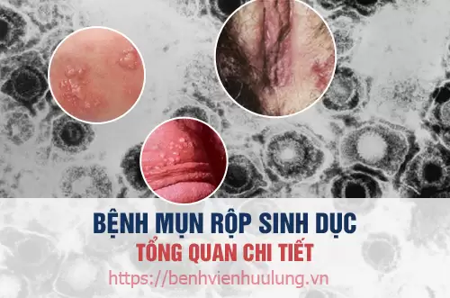 Tổng quan về bệnh mụn rộp sinh dục - Herpes sinh dục
