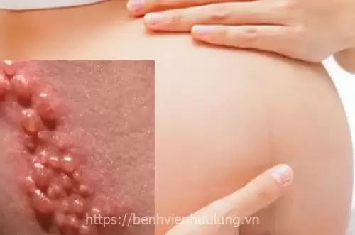 Mụn rộp sinh dục khi mang thai