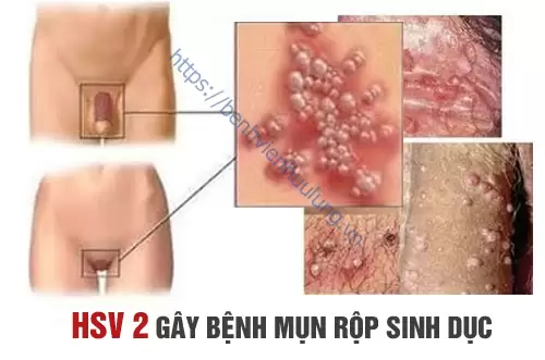Virus HSV gây mụn rộp sinh dục