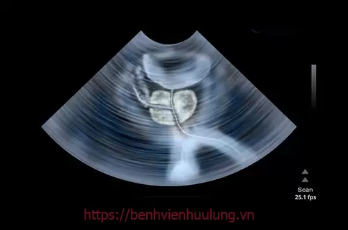 Nguyên nhân gây phì đại tuyến tiền liệt ở nam giới