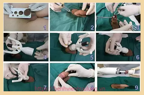 Cắt bao quy đầu là gì? Quy trình cắt bao quy đầu như thế nào?