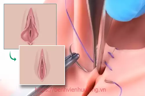 Thu nhỏ âm đạo hay thu nhỏ vùng kín