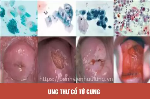 Bệnh ung thư cổ tử cung
