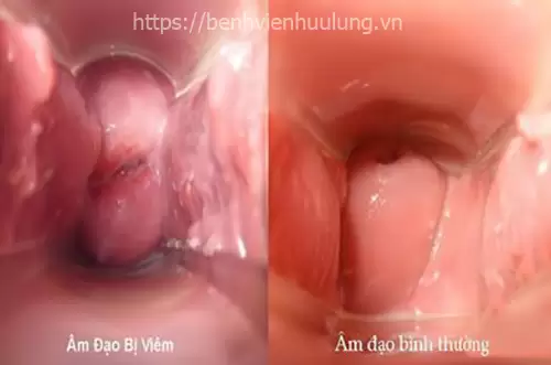 Bệnh viêm âm đạo