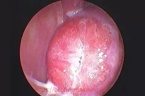 Bệnh viêm lộ tuyến cổ tử cung