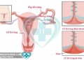 Bệnh viêm cổ tử cung là gì?