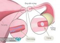 Thông tắc vòi trứng có đau không?